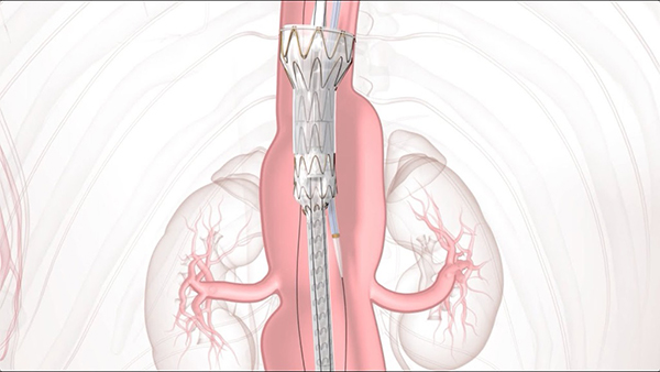 An illustration of a TAMBE device implanted in the body